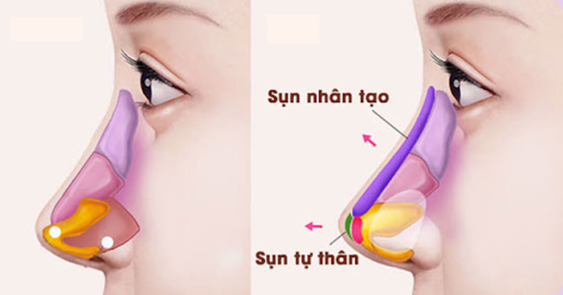 Nâng mũi bằng sụn nào đẹp nhất? So sánh ưu nhược điểm từng loại sụn